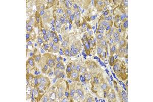 Immunohistochemistry of paraffin-embedded human liver cancer using MAGED1 antibody. (MAGED1 Antikörper)