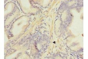 Immunohistochemistry of paraffin-embedded human prostate cancer using ABIN7160892 at dilution of 1:100 (NDUFA13 Antikörper  (AA 52-144))