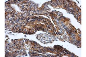 IHC-P Image HPRT antibody detects HPRT protein at cytoplasm in human colon cancer by immunohistochemical analysis. (HPRT1 Antikörper)