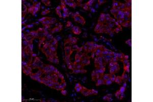 Immunofluorescence of paraffin embedded human breast cancer using Epl4 (ABIN7073843) at dilution of 1:2000 (300x lens) (EFNA4 Antikörper)