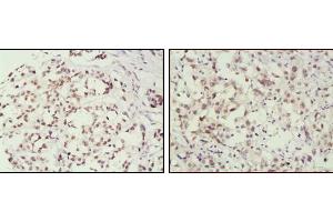 Immunohistochemical analysis of paraffin-embedded human breast cancer (left) and lung cancer (right) tissues, showing nuclear localization using MSH2 mouse mAb with DAB staining. (MSH2 Antikörper)