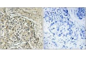 Immunohistochemistry analysis of paraffin-embedded human lung carcinoma tissue, using ARSD Antibody. (Arylsulfatase D Antikörper  (AA 331-380))