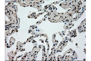 Immunohistochemical staining of paraffin-embedded Adenocarcinoma of breast tissue using anti-MKI67 mouse monoclonal antibody. (Ki-67 Antikörper  (AA 1-250))