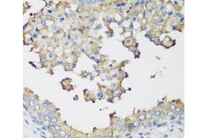 Immunohistochemistry of paraffin-embedded Human prostate using NEDD4L Polyclonal Antibody at dilution of 1:200 (40x lens). (NEDD4-2 Antikörper)