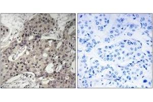 Immunohistochemistry analysis of paraffin-embedded human breast carcinoma tissue, using RPL3 Antibody. (RPL3 Antikörper  (AA 211-260))