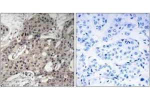 Immunohistochemistry analysis of paraffin-embedded human breast carcinoma tissue, using RPL3 Antibody.