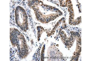 Immunohistochemistry of Human colon cancer using KLK7 Polyclonal Antibody at dilution of 1:10 (Kallikrein 7 Antikörper)
