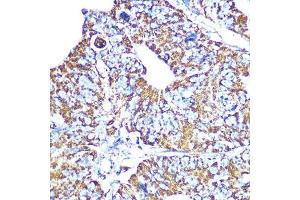 Immunohistochemistry of paraffin-embedded human colon carcinoma using HSP60/HSPD1 Rabbit mAb (ABIN1680746, ABIN3015220, ABIN3015221 and ABIN7101321) at dilution of 1:100 (40x lens). (HSPD1 Antikörper)