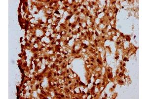 IHC image of ABIN7160108 diluted at 1:500 and staining in paraffin-embedded human melanoma performed on a Leica BondTM system. (MKL2 Antikörper  (AA 164-313))