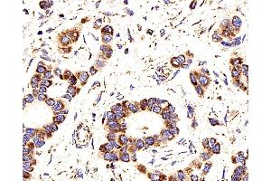 Immunohistochemistry analysis of paraffin-embedded human liver cancer using COX4I1 Polyclonal Antibody at dilution of 1:200. (COX IV Antikörper)