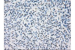 Immunohistochemical staining of paraffin-embedded Adenocarcinoma of colon tissue using anti-SSX2mouse monoclonal antibody. (SSX2 Antikörper)
