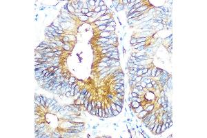 Immunohistochemistry of paraffin-embedded human colon carcinoma using Aquaporin-1 (Aquaporin-1 ) Rabbit mAb (ABIN1682901, ABIN3018679, ABIN3018680 and ABIN7101646) at dilution of 1:100 (40x lens). (Aquaporin 1 Antikörper)