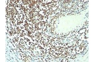 Formalin-fixed, paraffin-embedded human bladder carcinoma stained with Nucleolin antibody (364-5 + NCL/902).