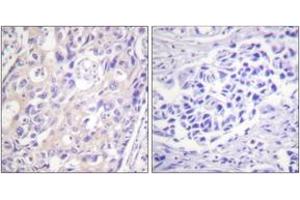 Immunohistochemistry analysis of paraffin-embedded human breast carcinoma, using p90 RSK (Phospho-Thr359+Ser363) Antibody. (RPS6KA3 Antikörper  (pThr359))