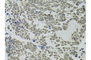 Immunohistochemistry of paraffin-embedded human lung cancer using PPP4C antibody (ABIN5971135) at dilution of 1/100 (40x lens). (PPP4C Antikörper)