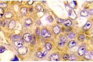 Immunohistochemistry (IHC) analyzes of BAD antibody in paraffin-embedded human breast carcinoma tissue. (BAD Antikörper)