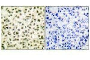 Immunohistochemical analysis of paraffin-embedded human breast carcinoma tissue using Ku70/80 antibody. (XRCC6 Antikörper)