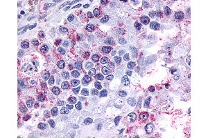 Anti-GPR3 antibody IHC of human Ovary, Carcinoma. (GPR3 Antikörper  (Extracellular Domain))