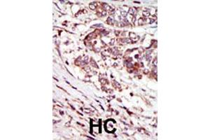 Formalin-fixed and paraffin-embedded human hepatocellular carcinoma tissue reacted with CAMK1G polyclonal antibody  , which was peroxidase-conjugated to the secondary antibody, followed by AEC staining. (CAMK1G Antikörper  (C-Term))