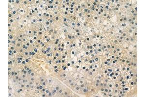 ABIN6259521 and ABIN6273956 at 1/100 staining human pancreatic carcinoma by IHC-P.
