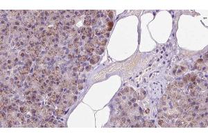 ABIN6273238 at 1/100 staining Human pancreas cancer tissue by IHC-P. (ETFA Antikörper  (Internal Region))