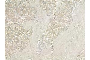 ABIN6258492 and ABIN6274927 at 1/100 staining human prostate carcinoma by IHC-P. (BCAS4 Antikörper  (Internal Region))