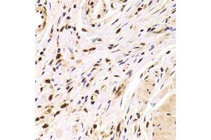 Immunohistochemistry of paraffin-embedded Human gastric cancer using PPP1R8 antibody at dilution of 1:100 (x400 lens). (PPP1R8 Antikörper)