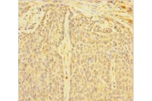 Immunohistochemistry of paraffin-embedded human ovarian cancer using ABIN7149718 at dilution of 1:100 (DNTTIP1 Antikörper  (AA 1-329))