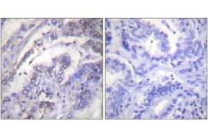 Immunohistochemistry analysis of paraffin-embedded human lung carcinoma tissue, using Histone H3 (Ab-3) Antibody.