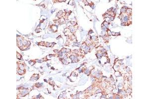 Immunohistochemistry of paraffin-embedded Human breast cancer using UBE2O Polyclonal Antibody at dilution of 1:100 (40x lens). (UBE2O Antikörper)