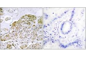 Immunohistochemistry analysis of paraffin-embedded human lung carcinoma tissue, using TFEB Antibody. (TFEB Antikörper  (AA 10-59))