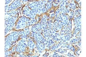 Formalin-fixed, paraffin-embedded human Melanoma stained with NGFR Monoclonal Antibody (NTR/912). (NGFR Antikörper)