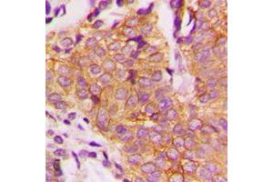 Immunohistochemical analysis of GSK3 beta (pS9) staining in human breast cancer formalin fixed paraffin embedded tissue section.