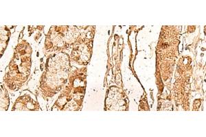 Immunohistochemistry of paraffin-embedded Human liver cancer tissue using WDR33 Polyclonal Antibody at dilution of 1:65(x200) (WDR33 Antikörper)
