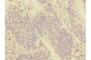 Immunohistochemistry of paraffin-embedded human colon cancer using ABIN7159959 at dilution of 1:100 (PMPCA Antikörper  (AA 456-525))