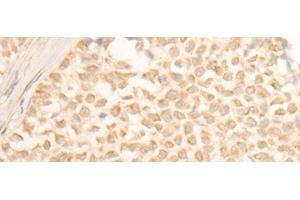 Immunohistochemistry of paraffin-embedded Human ovarian cancer tissue using CYP4X1 Polyclonal Antibody at dilution of 1:40(x200) (CYP4X1 Antikörper)
