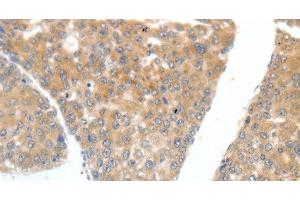 Immunohistochemistry of paraffin-embedded Human liver cancer tissue using FSHR Polyclonal Antibody at dilution 1:70 (FSHR Antikörper)