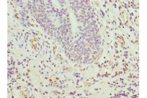Immunohistochemistry of paraffin-embedded human bladder cancer using ABIN7144067 at dilution of 1:100 (CIAPIN1 Antikörper  (AA 1-312))