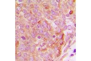 Immunohistochemical analysis of PP15 staining in human breast cancer formalin fixed paraffin embedded tissue section. (NUTF2 Antikörper)
