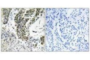 Immunohistochemistry analysis of paraffin-embedded human lung carcinoma tissue using RREB1 antibody. (RREB1 Antikörper)