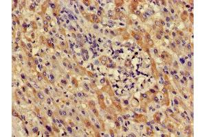 Immunohistochemistry of paraffin-embedded human liver cancer using ABIN7164407 at dilution of 1:100