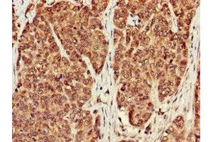Immunohistochemistry of paraffin-embedded human ovarian cancer using ABIN7169308 at dilution of 1:100 (PPP1CB Antikörper  (Catalytic Subunit))