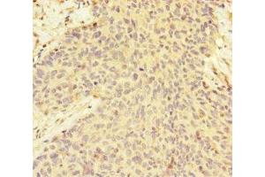 Immunohistochemistry of paraffin-embedded human ovarian cancer using ABIN7165791 at dilution of 1:100