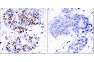 Immunohistochemistry analysis of paraffin-embedded human breast carcinoma tissue, using NF-kappaB p65 (Ab-276) Antibody. (NF-kB p65 Antikörper  (AA 249-298))
