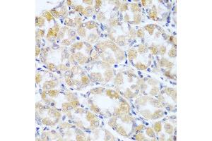Immunohistochemistry of paraffin-embedded human stomach cancer using ANKRD52 antibody at dilution of 1:100 (40x lens). (ANKRD52 Antikörper)