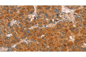 Immunohistochemistry of paraffin-embedded Human liver cancer tissue using RASA3 Polyclonal Antibody at dilution 1:35 (RASA3 Antikörper)