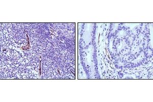 Immunohistochemical analysis of paraffin-embedded human lymph node (left) and colon cancer (right) tissues using eNOS mouse mAb with DAB staining. (ENOS Antikörper)