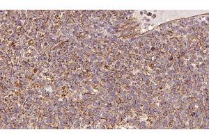 ABIN6273183 at 1/100 staining Human lymph cancer tissue by IHC-P.