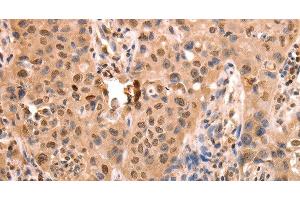 Immunohistochemistry of paraffin-embedded Human lung cancer using ACO2 Polyclonal Antibody at dilution of 1:30 (ACO2 Antikörper)