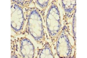 Immunohistochemistry of paraffin-embedded human colon cancer using ABIN7168062 at dilution of 1:100